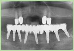 s02_implant08