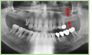 s02_implant14