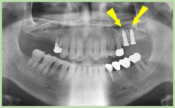 s02_implant15